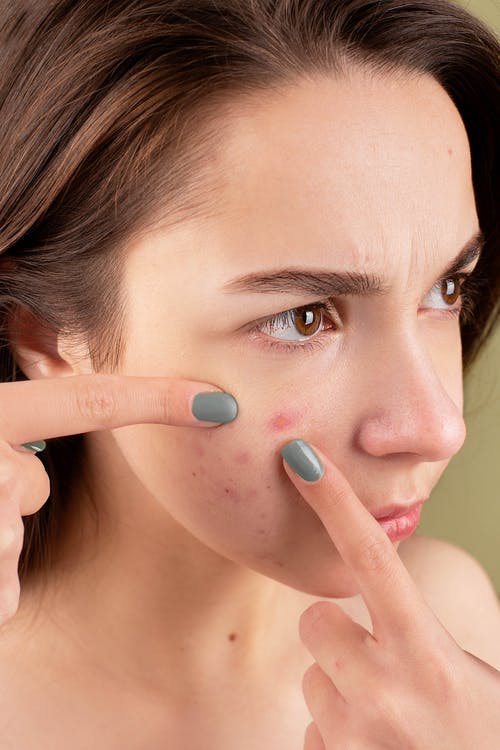 How to Improve Your Acne